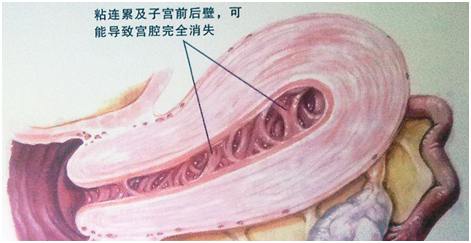 人流手术易引发宫腔粘连