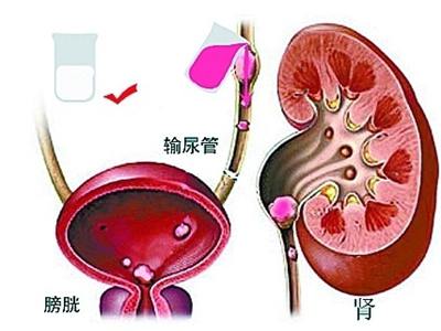 黃浦中西醫結合醫院三招教你防治輸尿管結石